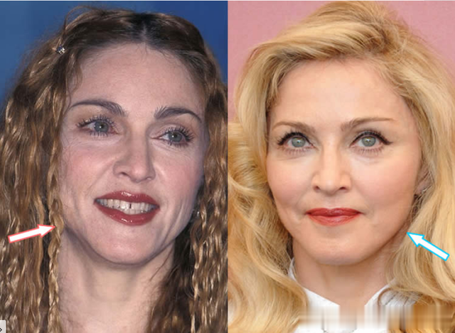 麦当娜|64岁麦当娜承认整容:术后消肿了,看我多可爱