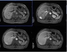 人参|骨是不是肝癌常见的转移部位,还有哪些?