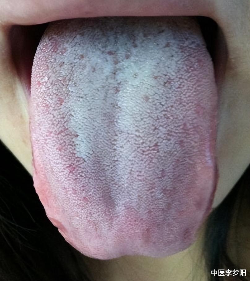 高血脂|舌苔厚就一定代表有湿气吗?李医生教你三个妙招,改善舌苔厚腻