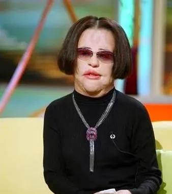 王一博|女星韩慧景:为了更漂亮,给脸注射食用油,把脸整成“猪头”