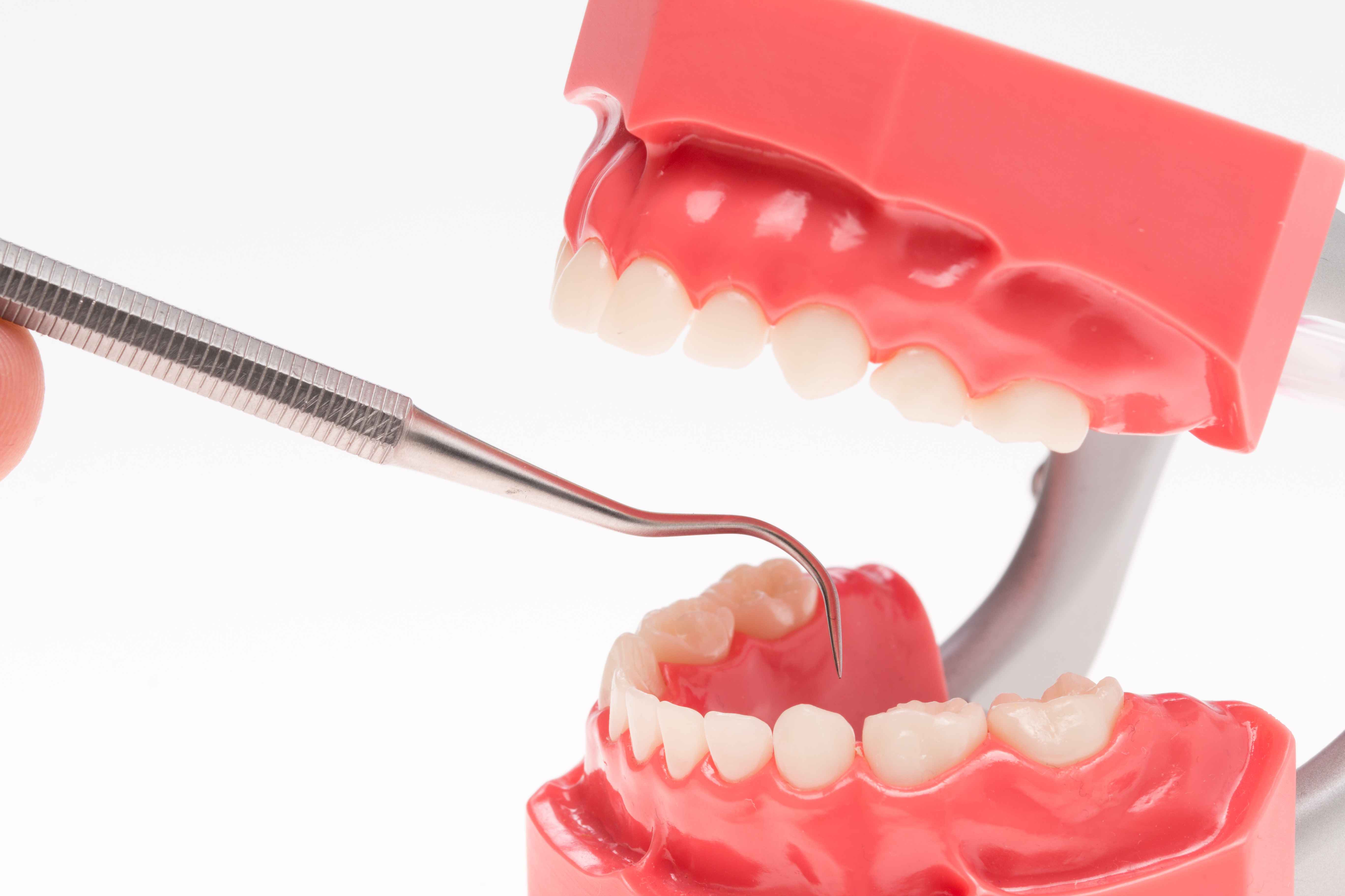 结肠癌|每天刷牙为何还会出现牙结石？牙结石究竟有何危害？一文科普