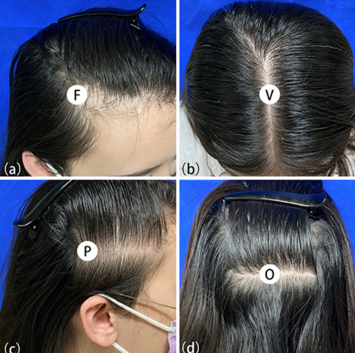 脱发|“米诺地尔”治脱发有副作用？哪些人不能用？不妨收藏以便查看