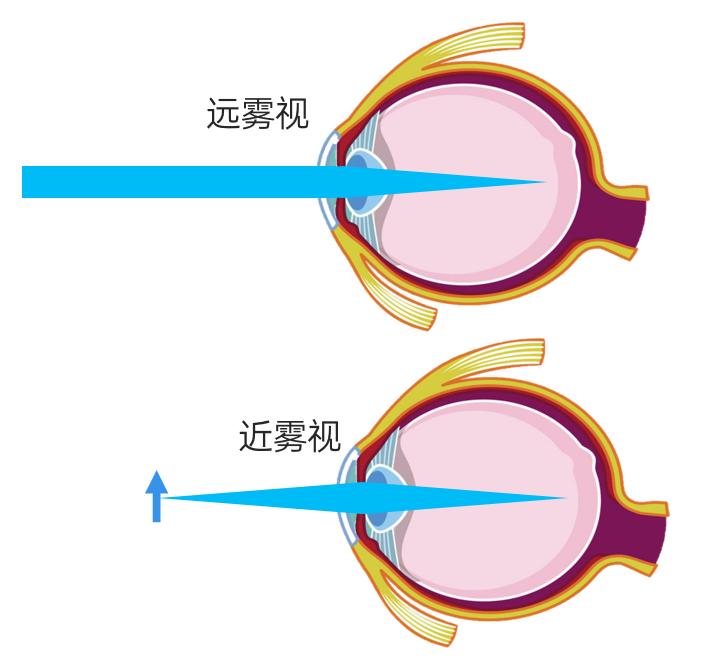 近视|第四讲(5)中心成像超前--雾视治疗概述