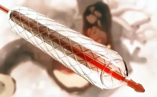700元心脏支架“涨”回5万,医代解释:700元的不好用