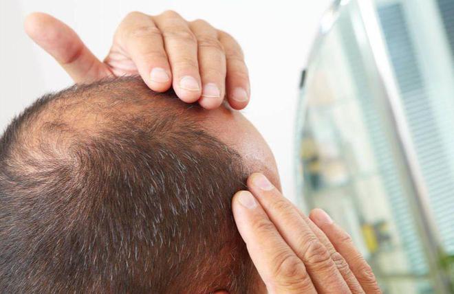 脱发|爱脱发,肾气不足!中医“土方子”,补肾、补血、祛风,望笑纳