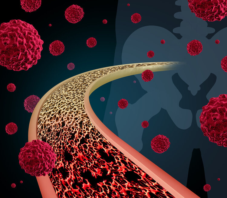 癌细胞|饿死癌细胞,已证实有效,定位准损伤小,多种癌症可用