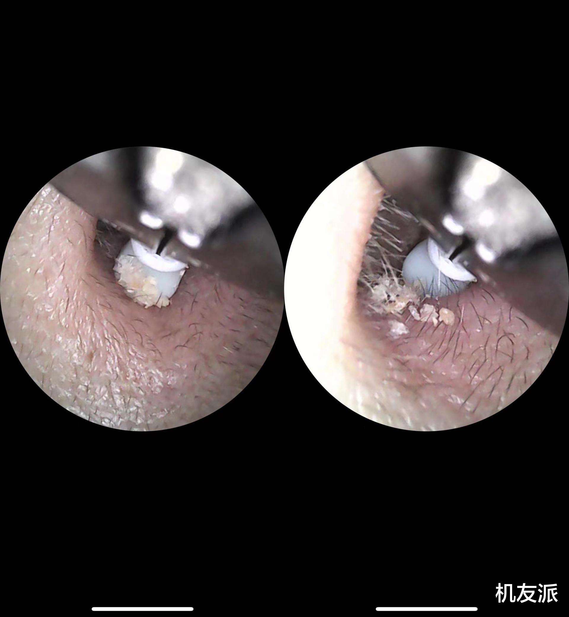 硅胶|告别耳屎！采耳神器Note3 Pro Max体验，真的会上瘾