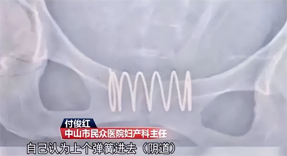 2019年广东一女子,为避孕将弹簧塞进体内,最终酿成一桩悲剧