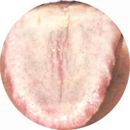 失眠|中医中的舌诊，了解吗