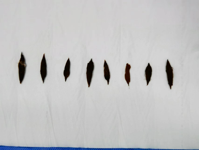 粽子|两天12例枣核卡食道,专家建议制作粽子时取出枣核