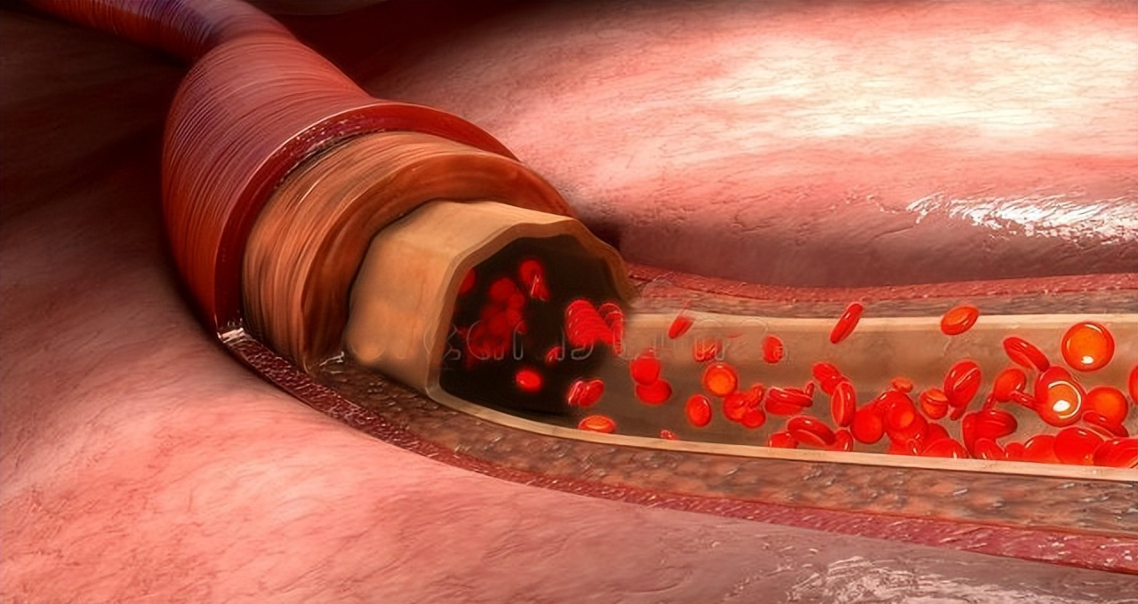 养生|人体血管寿命有多长,人的生命就有多长,如何才能延长血管生命?