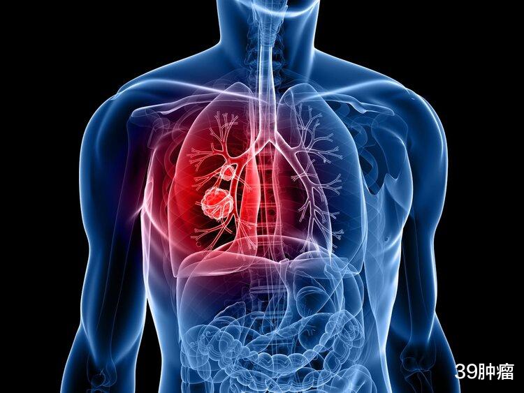 肺癌|54岁男子双脚水肿，诊断肾病，直到出现咳嗽才发现是肺癌