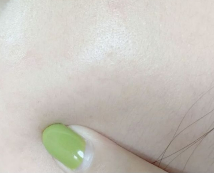 过敏 孕期水乳如何选？二胎宝妈护肤经验分享，长痘过敏干痒的宝妈必看