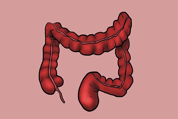 结肠息肉|肠道总爱长息肉？了解原因，找对方法，或能让肠道重新变光滑