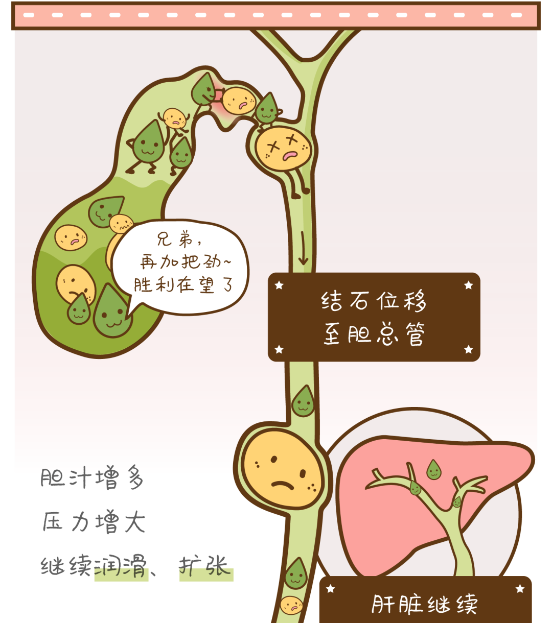 心脏病|胆结石是如何排出体外的?会划破胆管吗?