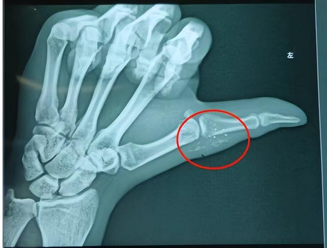 医生|体温计水银入体 一月后男子手部组织坏死