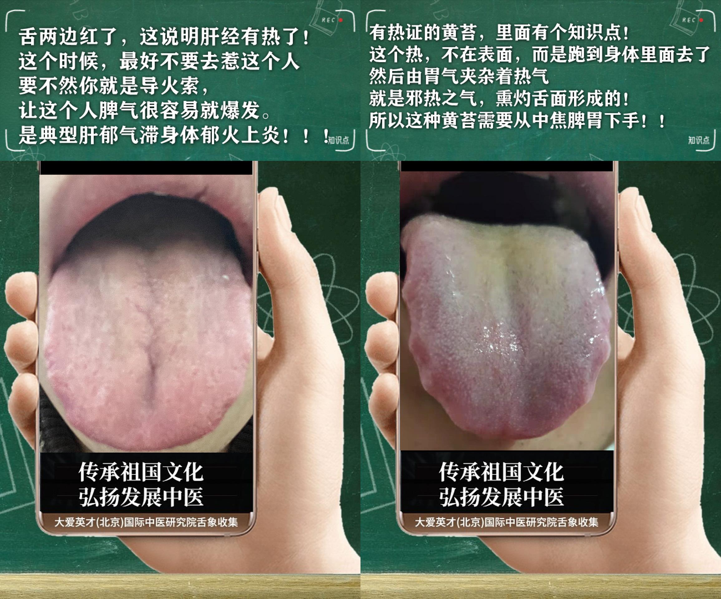 静脉曲张|中医解析：胸闷恶心，排便无力，经常耳鸣，肺气不固