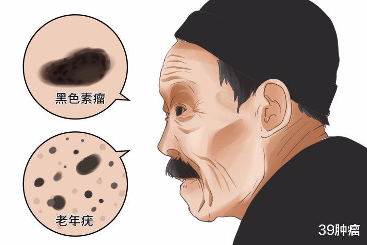 退休|60-64岁癌症高发，2个原因很难避免，退休人尤其值得警惕