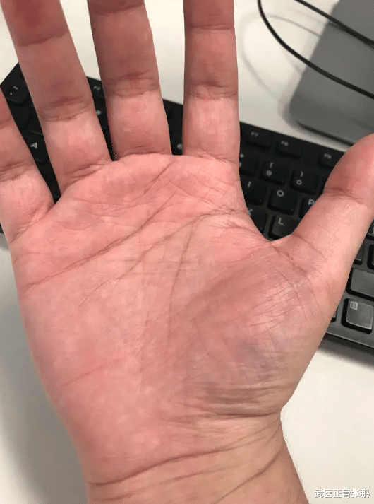 维生素b6|28岁男子不痛不痒,确诊为肝癌,医生:工作时,2习惯是“祸根”