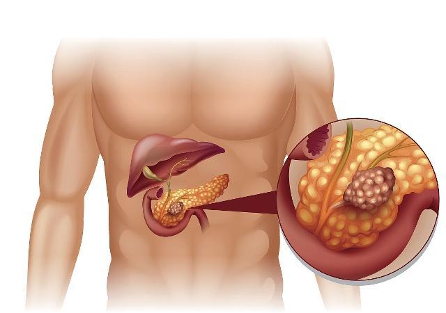 二甲双胍|胰腺癌是“癌症王”，身体有3个表现，可能是它靠近的“脚步声”