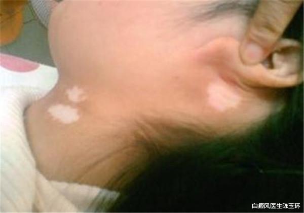 便秘|白癜风患者如何正确面对婚恋问题？