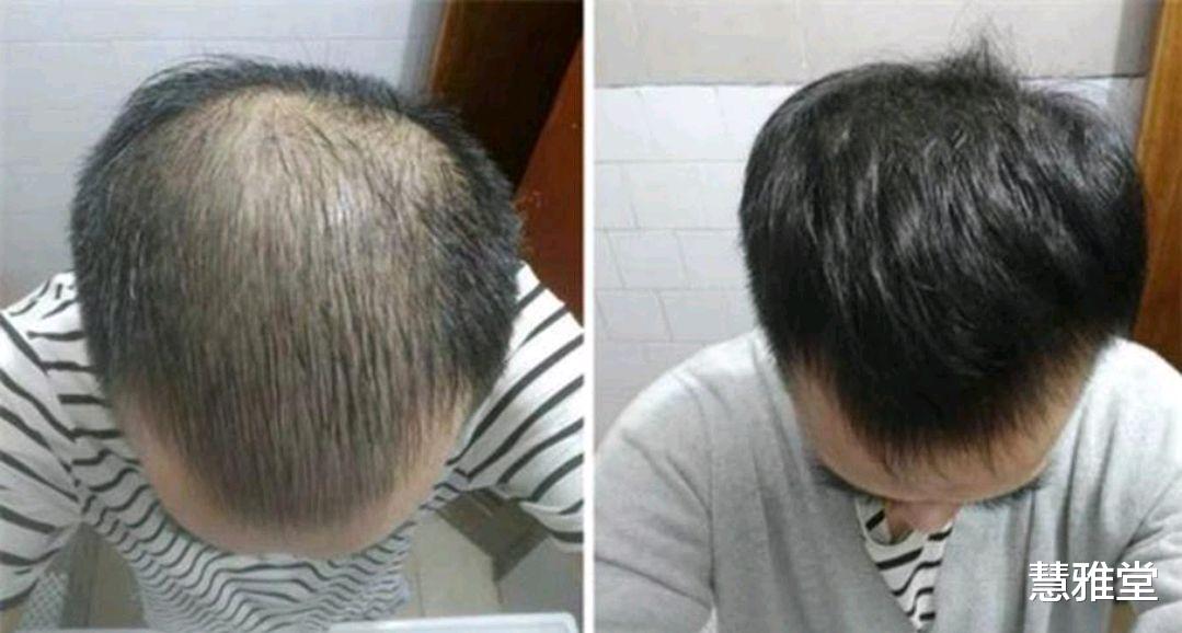 洗发水|如何预防头发稀少的现象？4个日常方法，长期坚持，或能帮到你