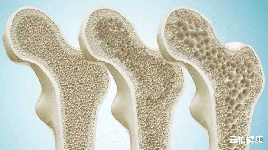 骨质疏松|骨质疏松越来越严重，日常坚持2件事，或能强健骨骼