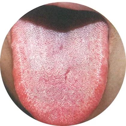 失眠|中医中的舌诊，了解吗