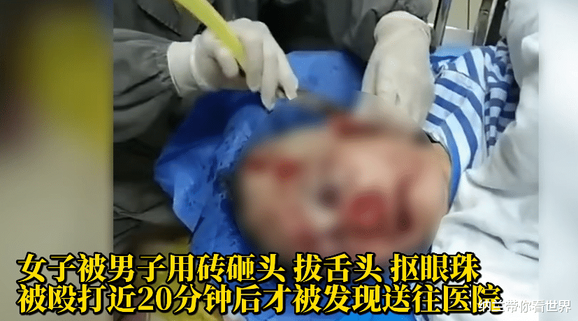 厕所被殴打女子右眼视力只有0.04,复明希望很小,至今未收到道歉