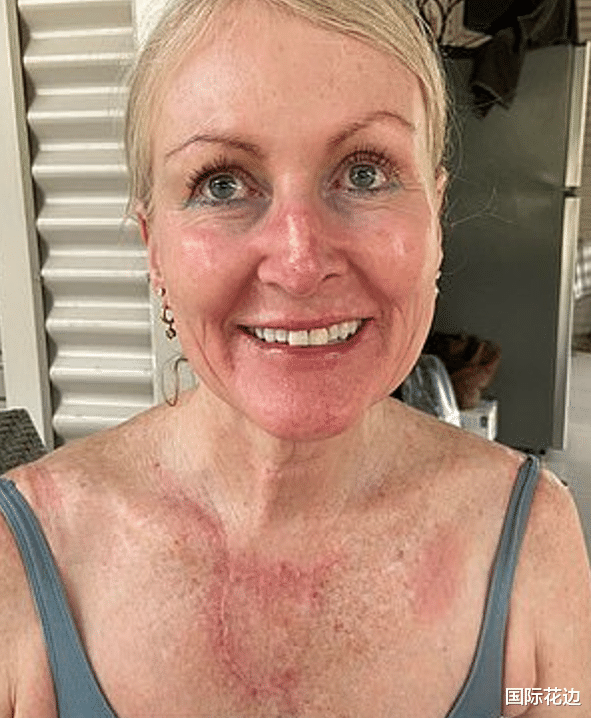 明星素颜|澳洲女子身上长斑没在意，美容师让她赶紧去看，一查是癌症
