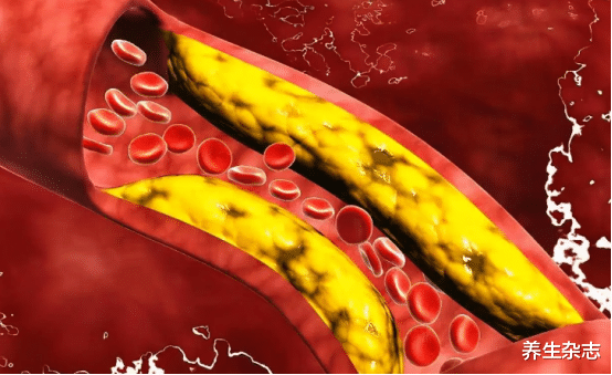 胆固醇|胆固醇“大户”被揪出，是猪油的10倍，医生：不想脑梗逼上门，趁早扔