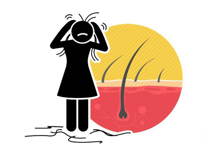 脱发|每天洗头不一定加重脱发！多久洗一次才好？不同发质不同要求