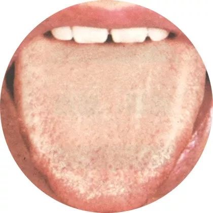 失眠|中医中的舌诊,了解吗