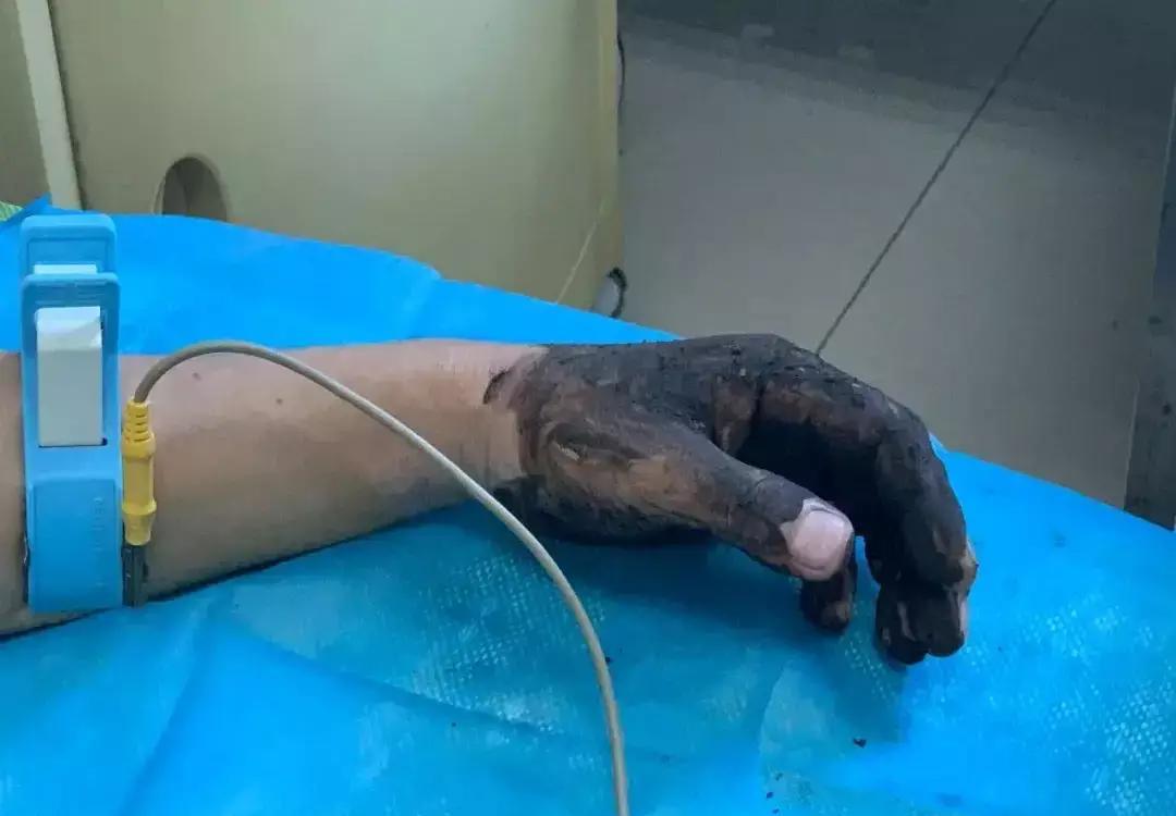 “人没事,蛇死了”!印度8岁男孩被眼镜蛇咬伤后,反口将蛇咬死
