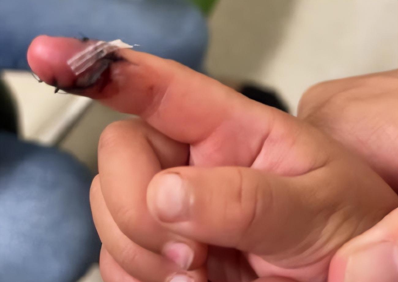 郑爽|郑爽虐童风波升级!孩子深度割伤烫伤,郑爽称是玻璃女儿称是剪刀