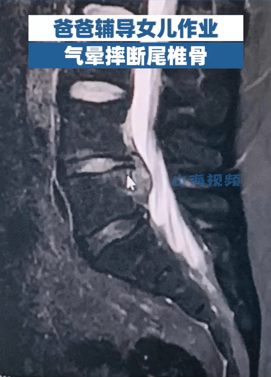 爸爸辅导女儿作业被气到摔倒,致尾椎骨断裂,妈妈:他为了逃避辅导作业不想出院