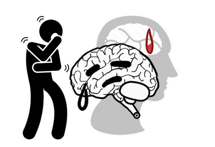 脑梗|吃出来的脑梗！喜欢3种饮食的人，不想给脑血管添堵，请撤下饭桌