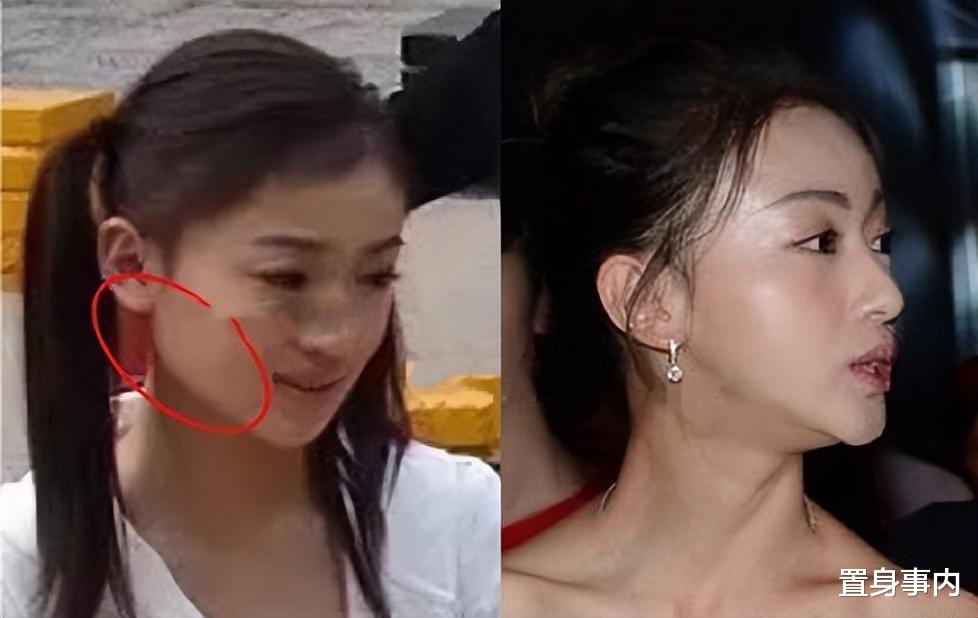 洗发水|明星整脸有多拼？“一刀切”说做就做，有女星因后遗症影响一生