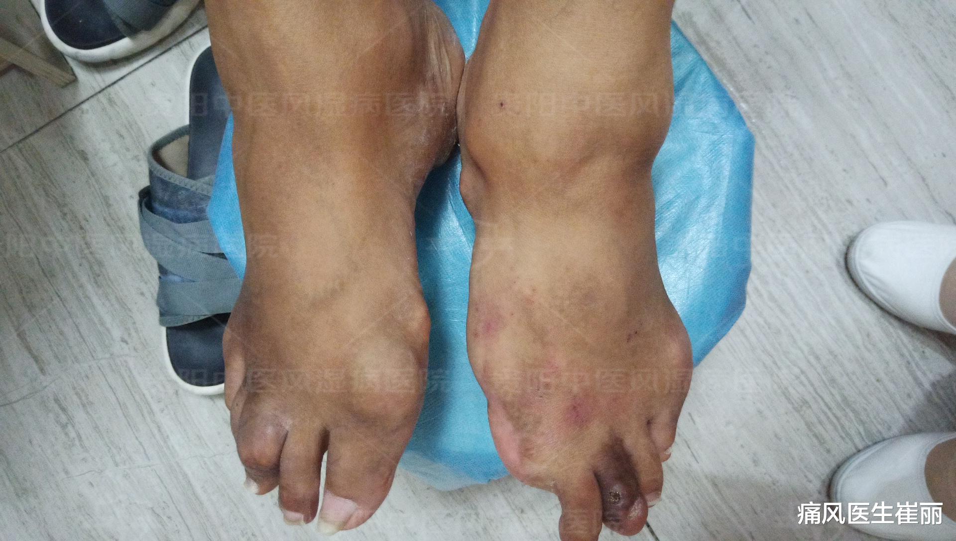 香蕉|巧用这两种方法,不再烦恼痛风