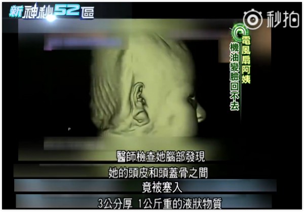 韩慧景|女星韩慧景：为了更漂亮，给脸注射食用油，把脸整成“猪头”