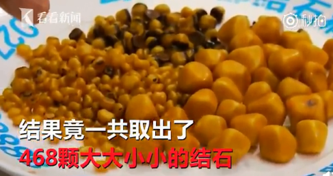 中药|女子体内取出468颗结石:惜命的最好方式不是养生,而是好好吃饭