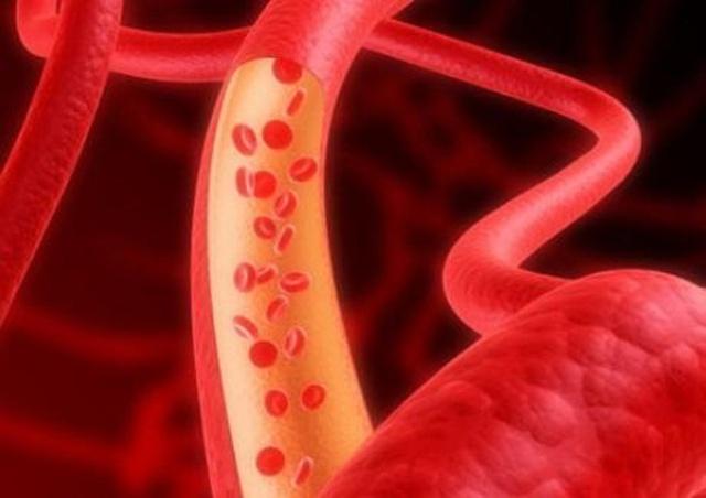 |你会得心梗脑梗吗?看看这项指标吧,它能告诉你可能性有多大