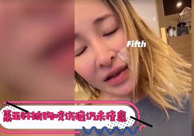 萧亚轩|萧亚轩素颜直播，受伤右脸还未完全恢复，坦言用一年多接受现实