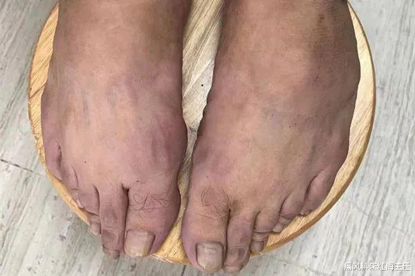 尿酸|教你一个方法，让你少吃药还能把尿酸降下去！