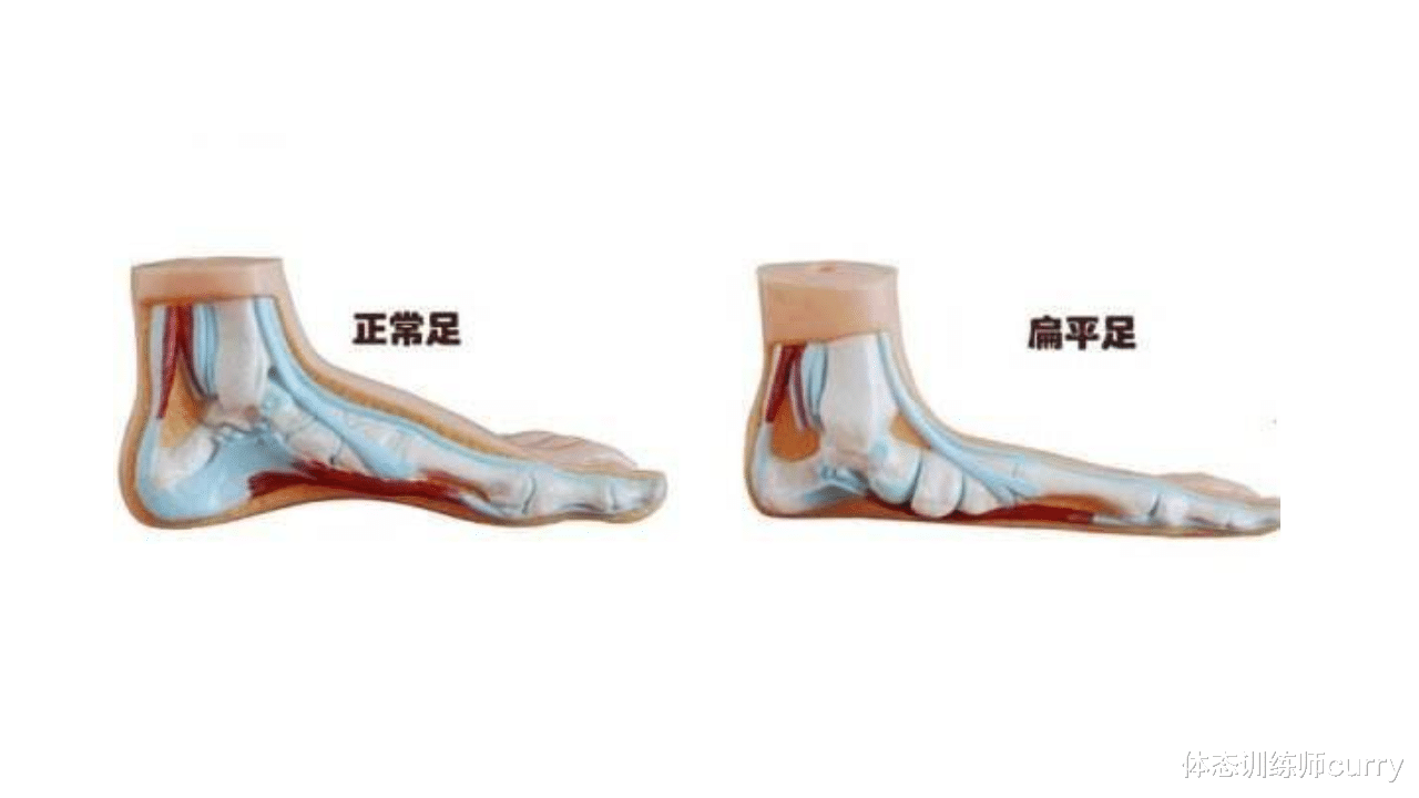 疾病|身体好不好,看鞋就知道?骨科大夫:鞋底穿成5个模样,该留意了