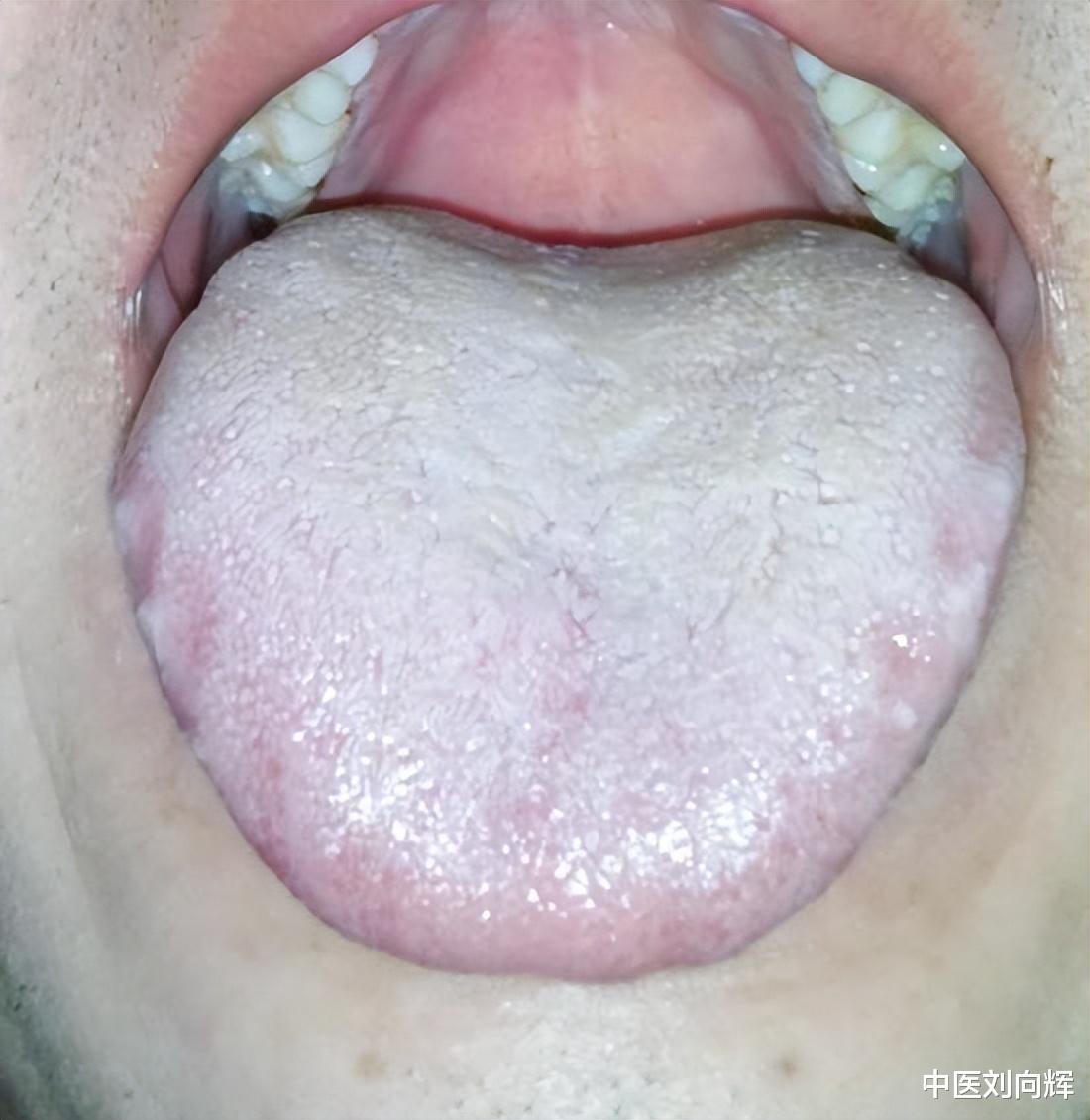 咽炎|嗓子里总有痰？还多的吐不完？参苓白术丸没用？教你一招作用翻倍