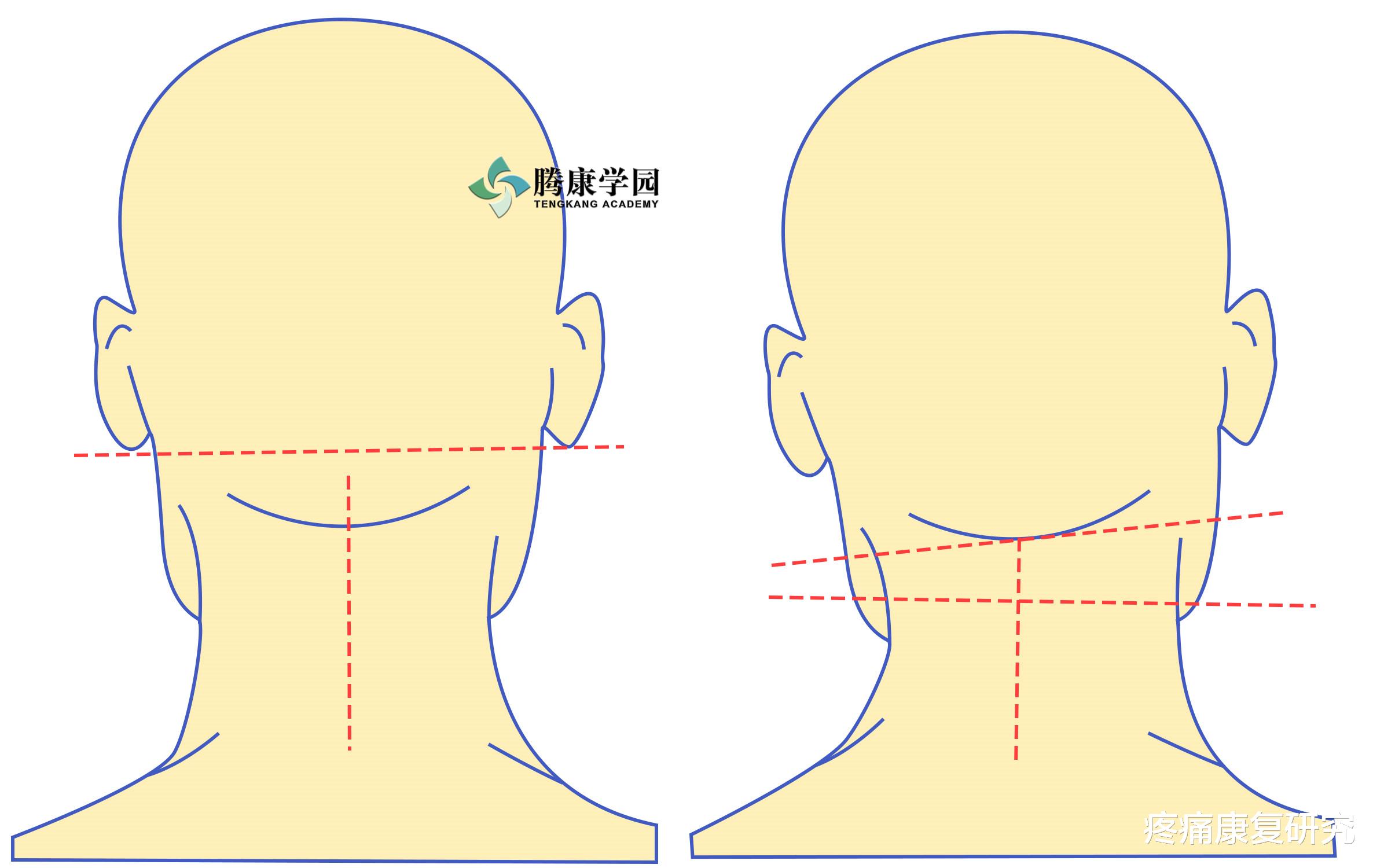 医院|颈椎病的姿势测试和动作评估及治疗