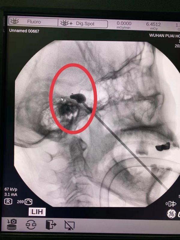三叉神经痛|医生种下一颗“梨子”,治好十年三叉神经痛