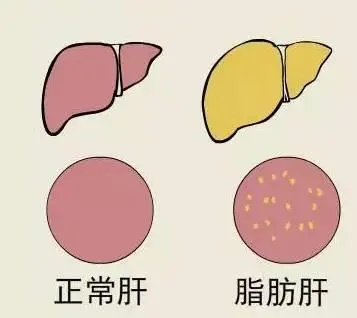 肝硬化|脂肪肝也会进展到肝硬化，不可小瞧它！