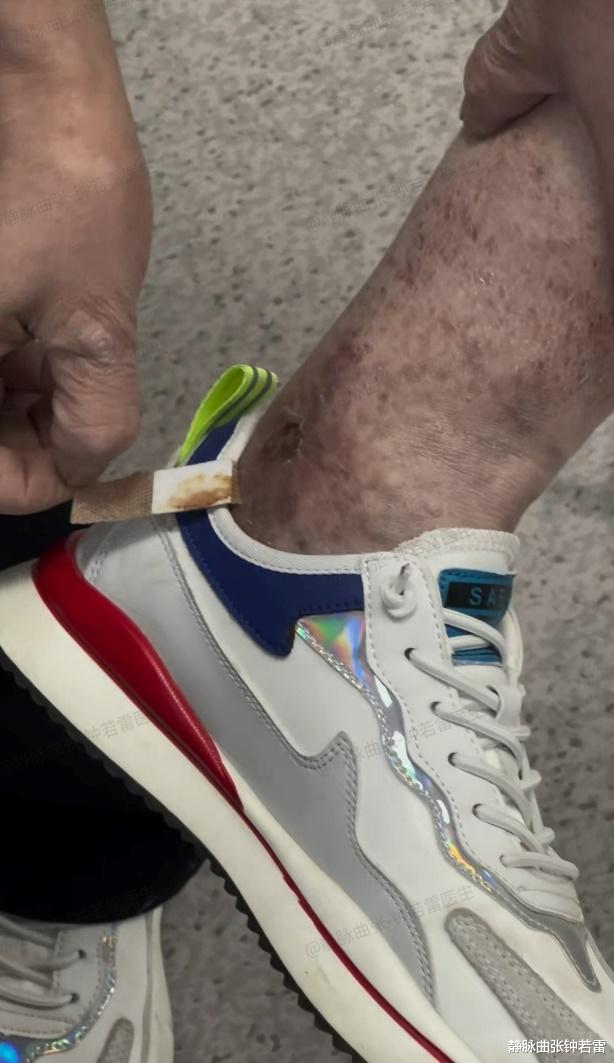 肥肠|小腿血管突出看着像肥肠,被折磨多年的送奶员,谋生路上不敢停